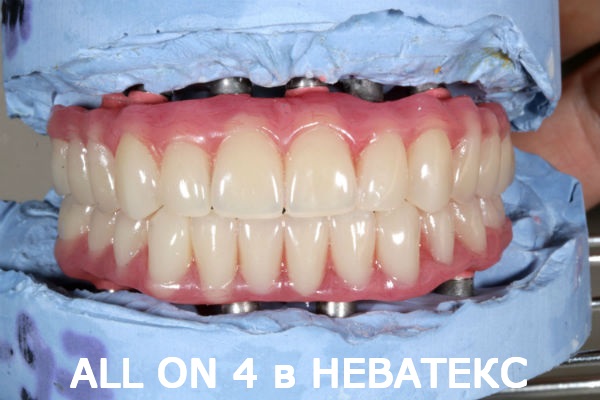 allon4 протезы вид спереди клиника неватекс allon4 протезы вид спереди